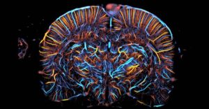 Primeiro ultrassom funcional cerebral do Brasil